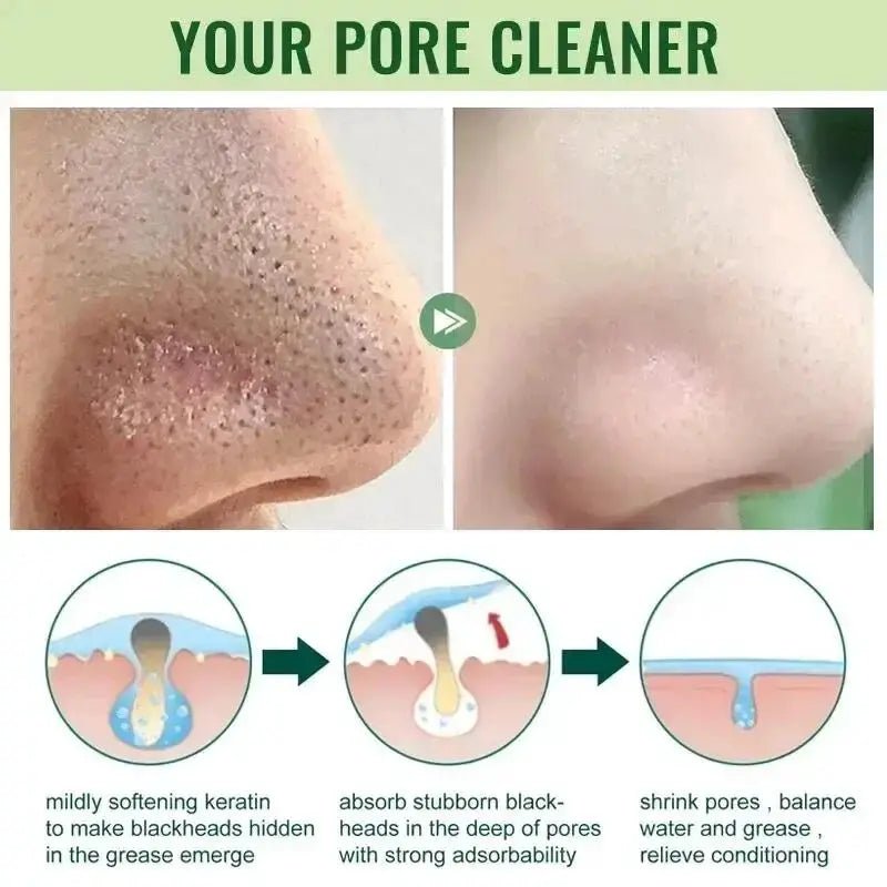 Acne Mask for Acne Prone Skin Pore Care