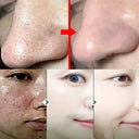 Acne Mask for Acne Prone Skin Pore Care