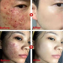 Acne Mask for Acne Prone Skin Pore Care