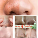 Acne Mask for Acne Prone Skin Pore Care