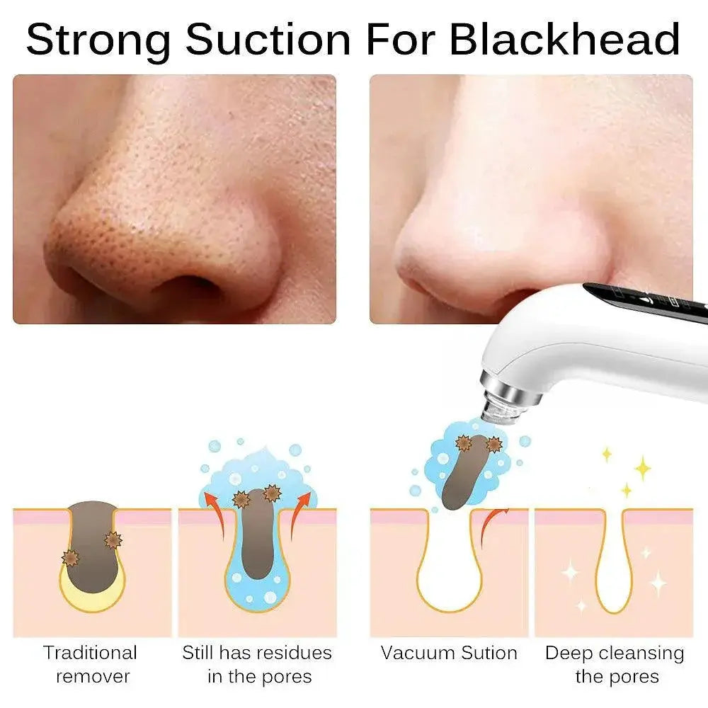 Blackhead Vacuum Pore Cleaner Powerful Skin Purifier Pro
