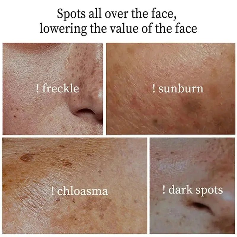 Brightening Cream for Melasma and Spots
