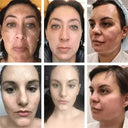Brightening Cream for Melasma and Spots