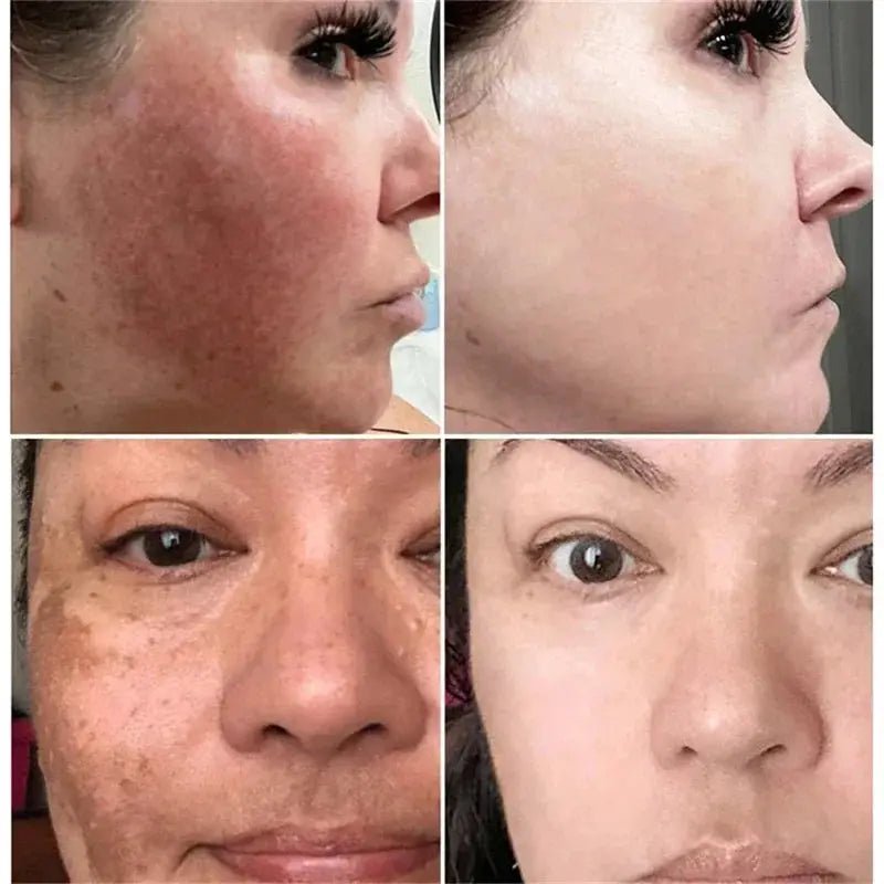 Brightening Cream for Melasma and Spots