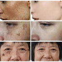 Brightening Cream for Melasma and Spots