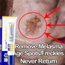 Brightening Cream for Melasma and Spots