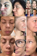 Brightening Melasma Cream for All Skin