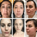 Brightening Melasma Cream for All Skin