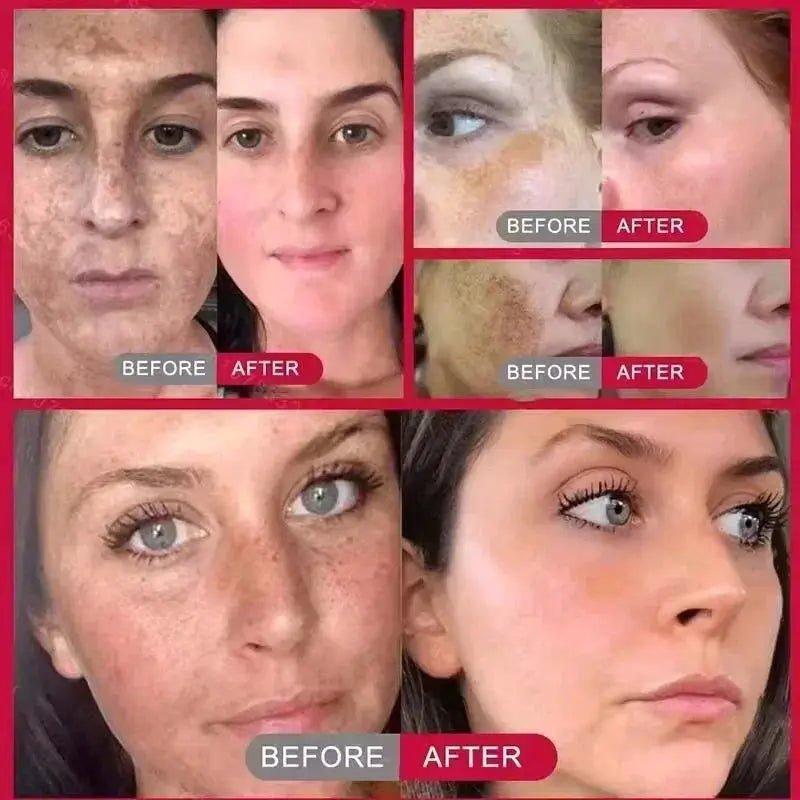 Brightening Melasma Cream for All Skin