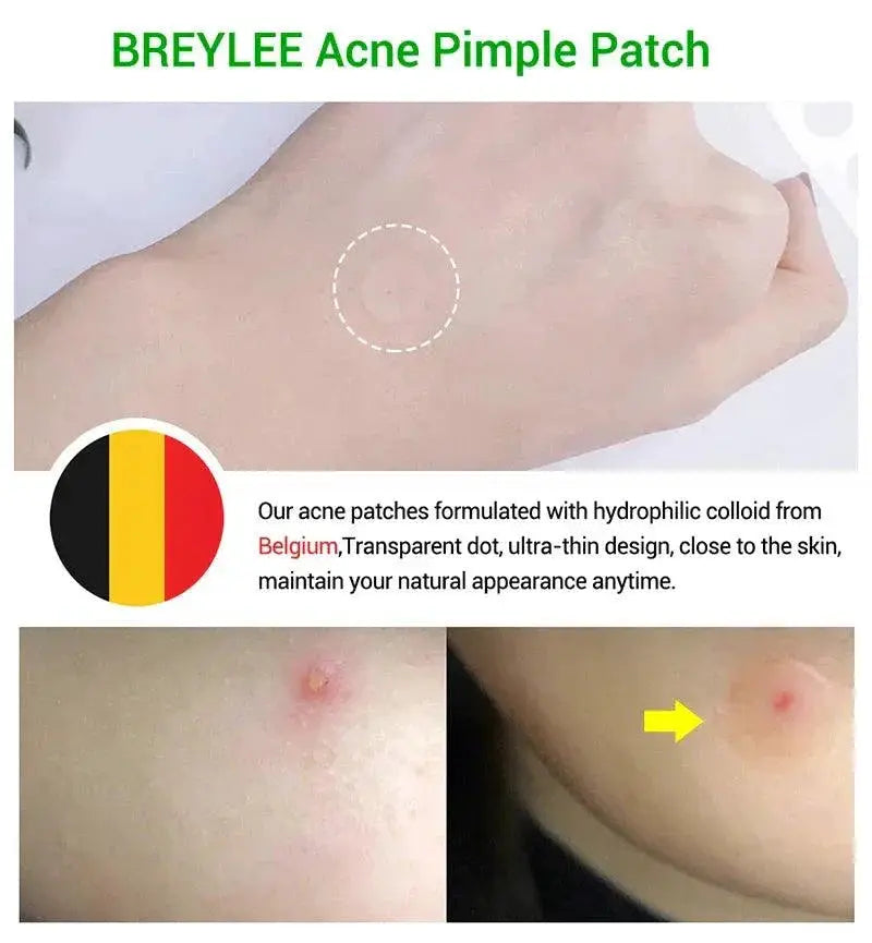 Clear Skin Acne Patches Advanced Hydrocolloid Treatment Pack