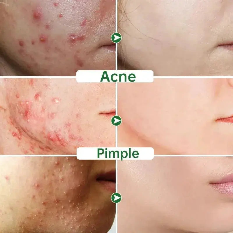 ClearSkin Herbal Acne Cream Plant Powered Skin Solution
