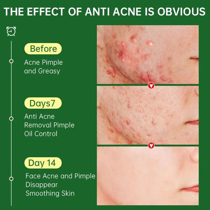 ClearSkin Herbal Acne Cream Plant Powered Skin Solution