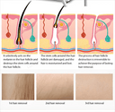 Diode Laser Hair Removal System for Spa