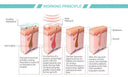 Diode Laser Hair Removal System for Spa