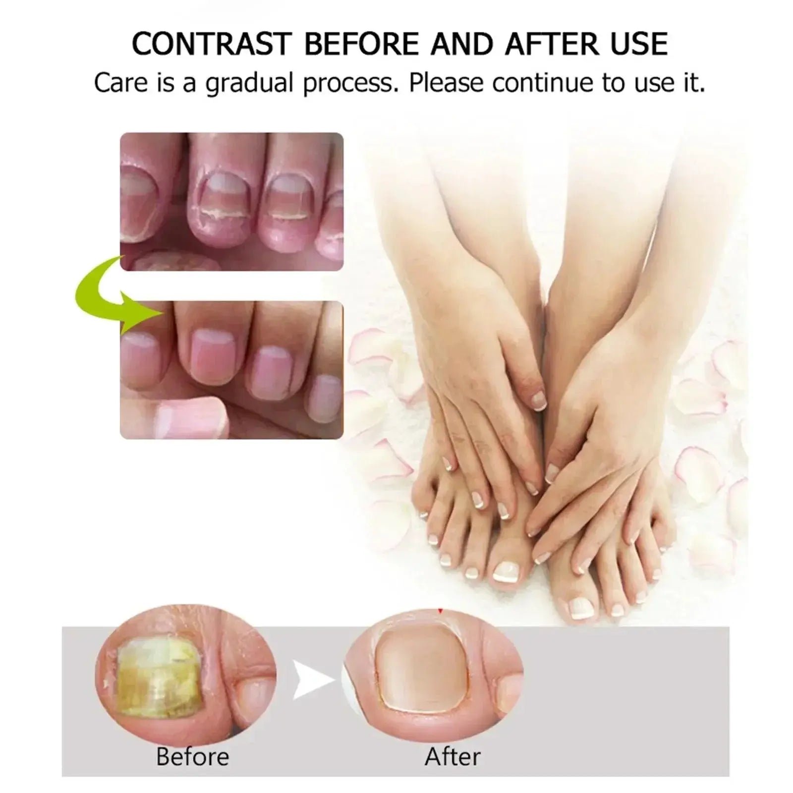 EFERO Nail Fungus Repair Serum Nourish Nails And Infections