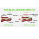 EFERO Nail Fungus Repair Serum Combat Infections Nourish Nails