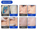 Efficient Hair and Tattoo Removal Device