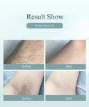 Gentle IPL Hair Removal Device for Home