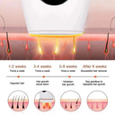 Gentle IPL Hair Removal Device for Home