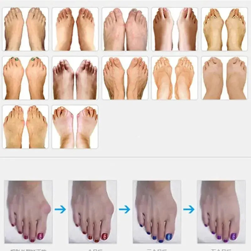 Hallux Valgus Relief Toe Alignment Set For Pain Relief