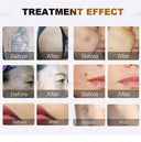 Home Hair Removal Laser for Gentle Grooming