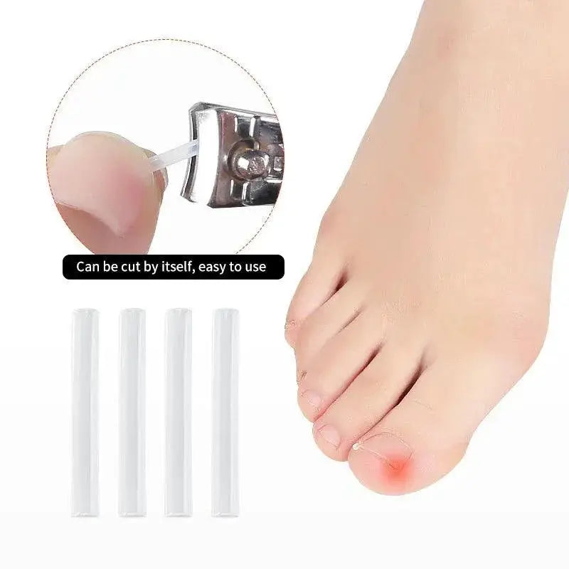 Ingrown Toenail Correction Kit For Home And Professional Use