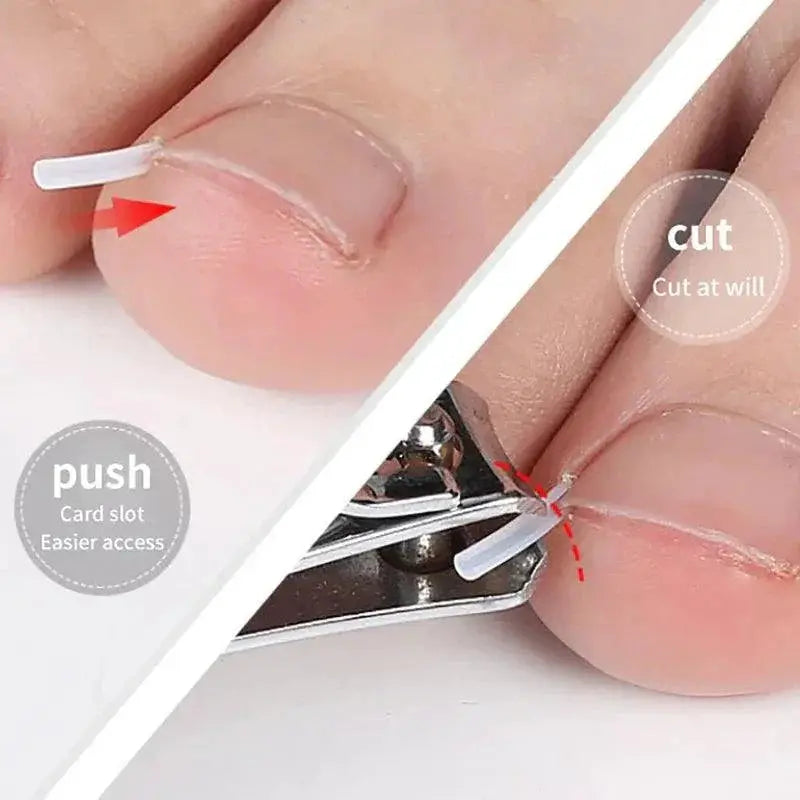Ingrown Toenail Correction Kit For Home And Professional Use