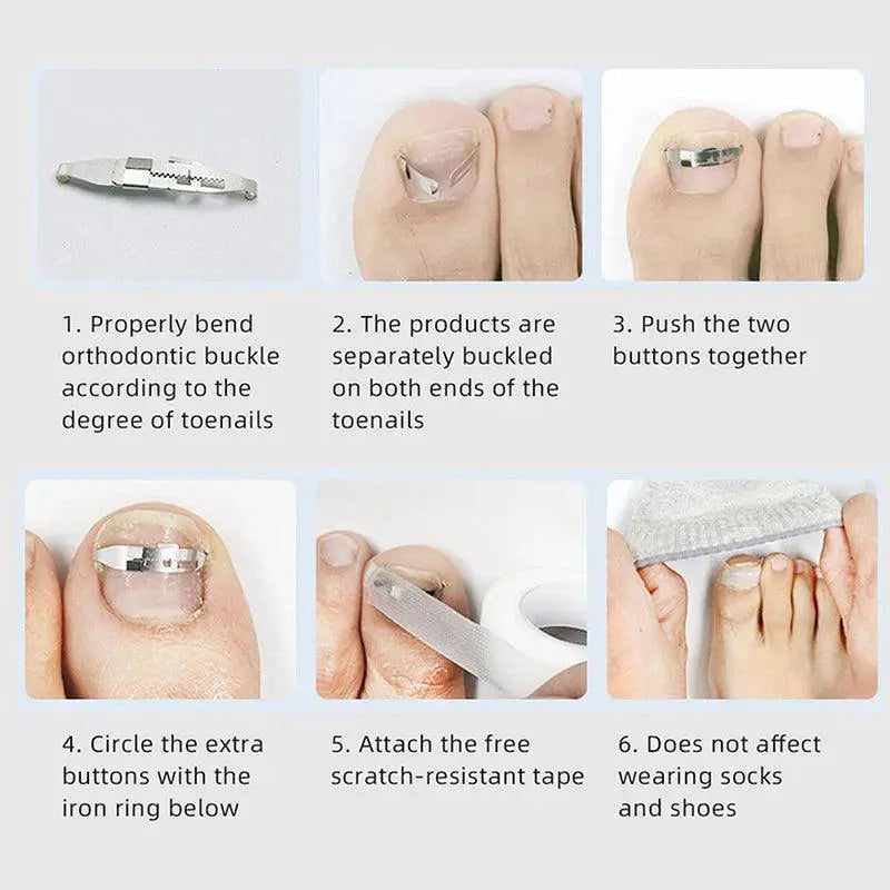 Ingrown Toenail Corrector Kit For Home Foot Care Solution