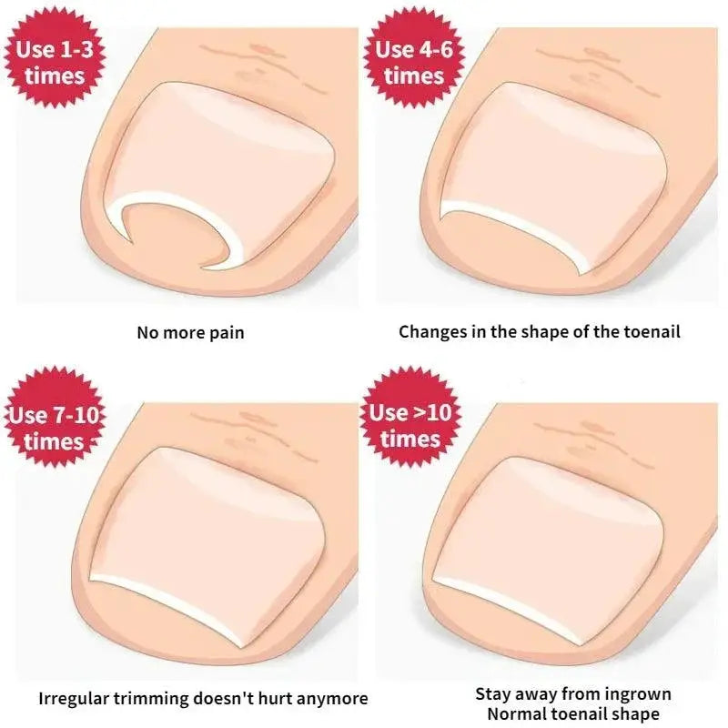 Ingrown Toenail Corrector Pro Foot Care Tool At Home