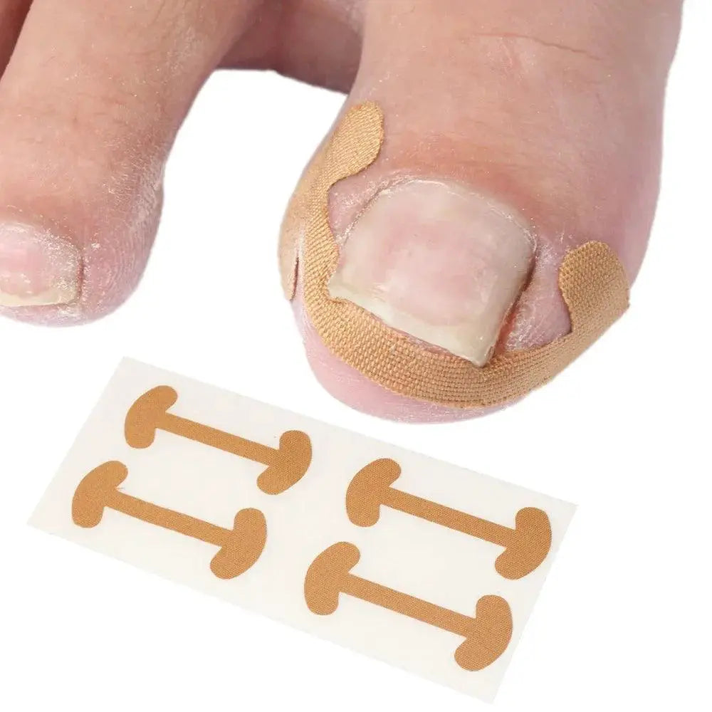 Ingrown Toenail Corrector Stickers For Healthy Nail Growth