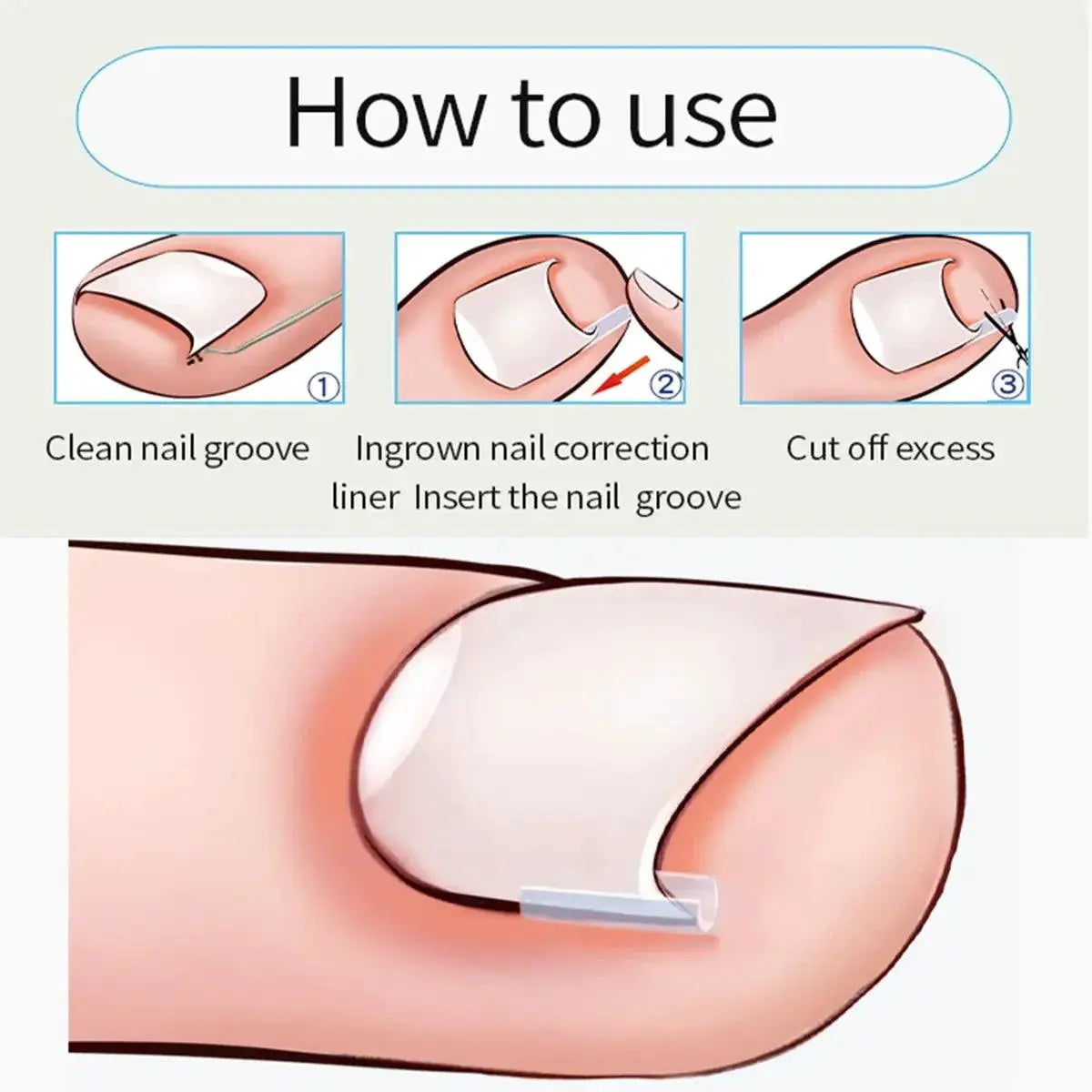 Ingrown Toenail Relief Orthopedic Nail Correction Tool
