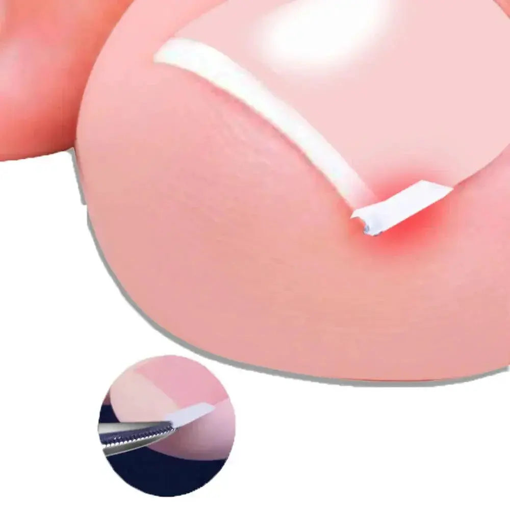 Ingrown Toenail Relief Orthopedic Nail Correction Tool