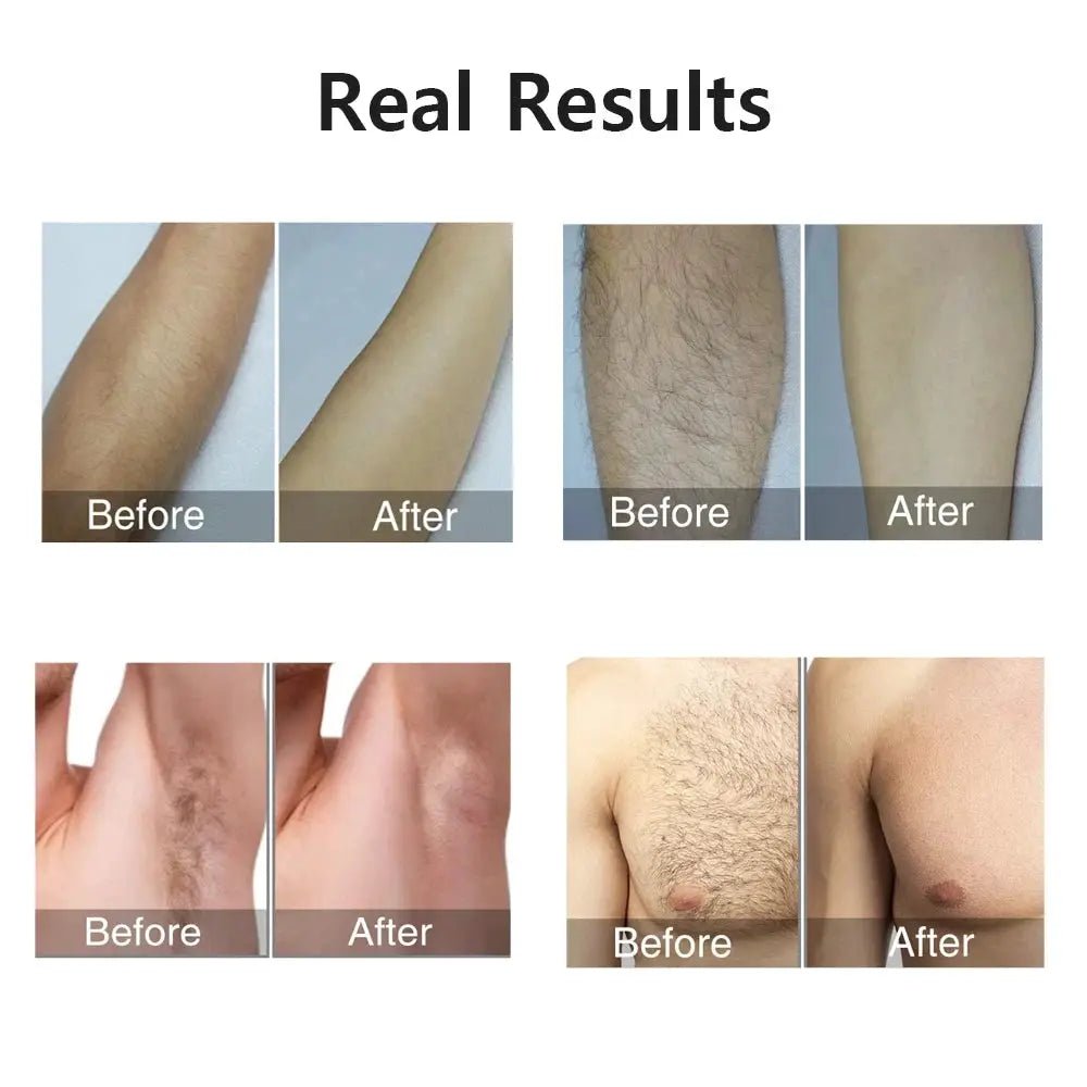 IPL Hair Removal Device For Home