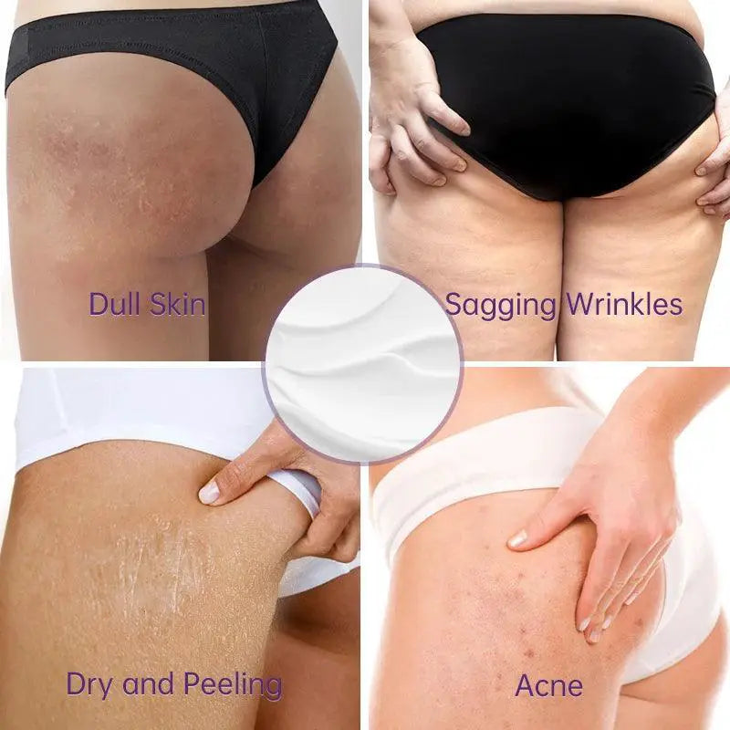 Acne Treatment Cream For Buttocks And Thighs Fast Relief