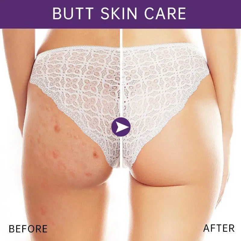 Acne Treatment Cream For Buttocks And Thighs Fast Relief