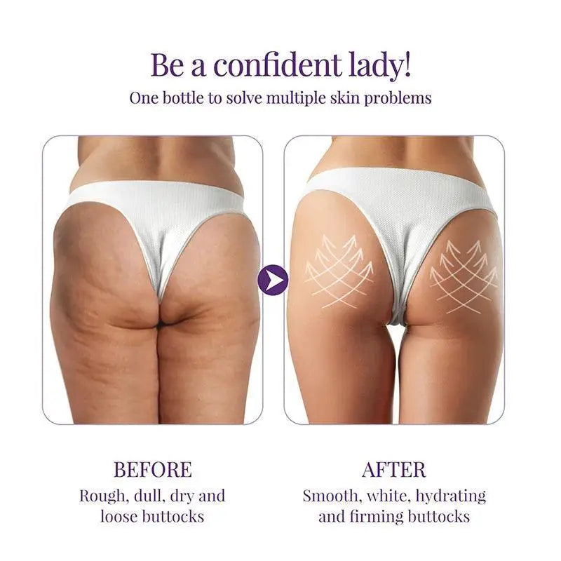 Acne Treatment Cream For Buttocks And Thighs Fast Relief
