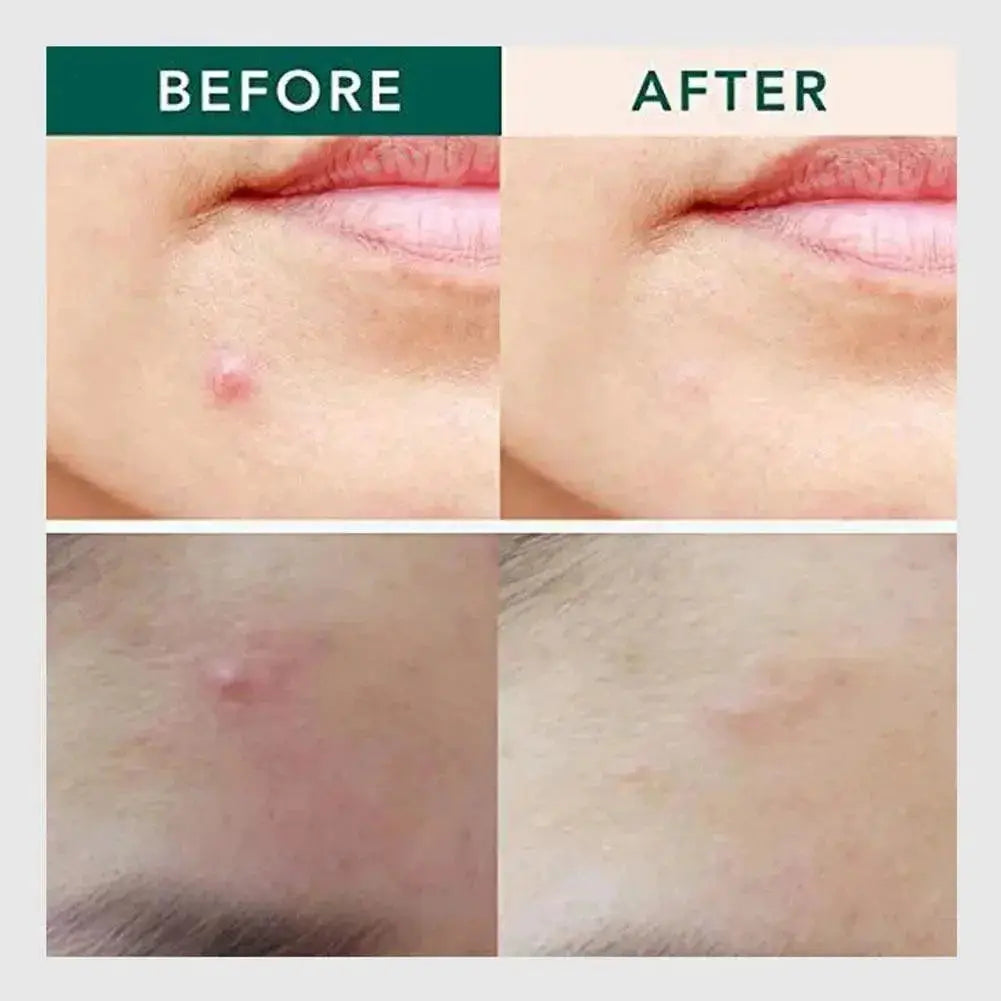 Youthful Hydration Hyaluronic Acid Acne Pimple Repair Patches