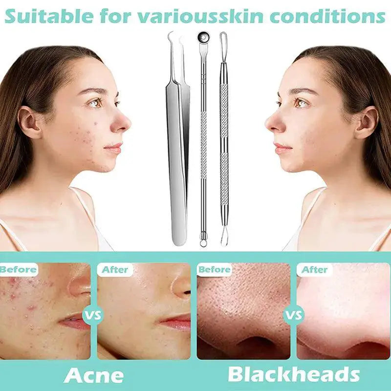 Stainless Steel Blackhead Removal Kit For Clear Skin