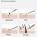 Blackhead Removal Kit for All Skin Types