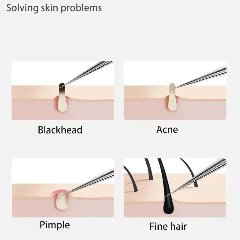 Stainless Steel Blackhead Removal Kit For Clear Skin