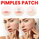 Fast Healing Acne Patches for On-the-Go