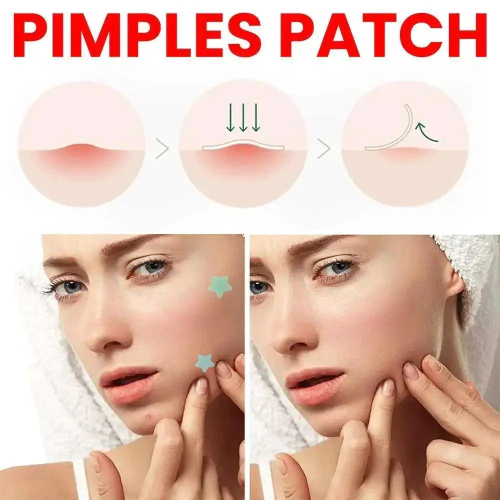Acne Treatment Patches for Fast Healing and Clear Skin