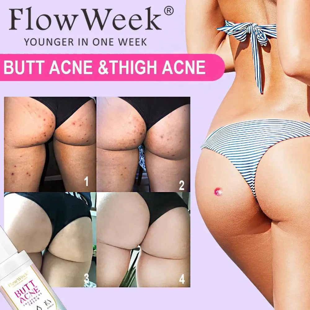 Niacinamide Booty Cream For Acne And Dark Spots Brightening