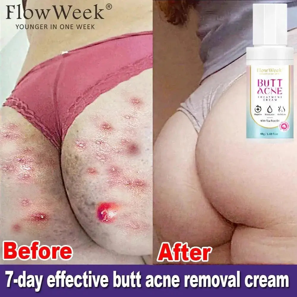 Niacinamide Booty Cream For Acne And Dark Spots Brightening