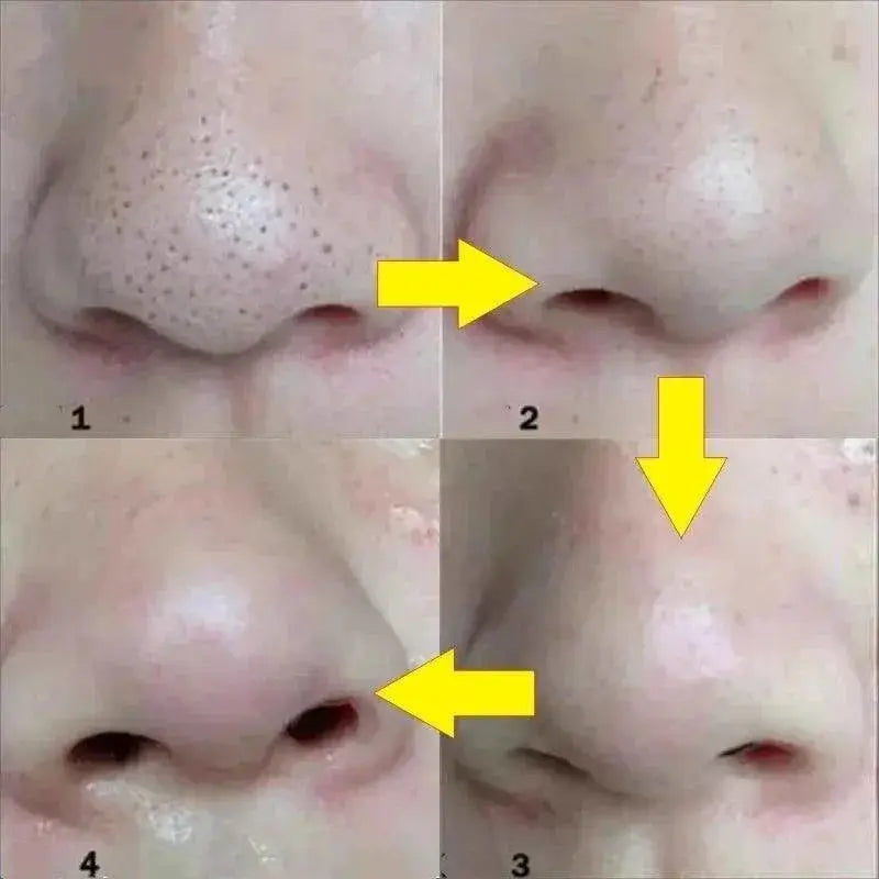 Ultimate Blackhead Removal Peel Mask And Pore Cleansing Kit