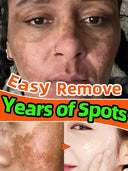 Melasma Dark Spot Serum for Even Tone
