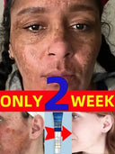 Spot Correcting Cream for Melasma Care