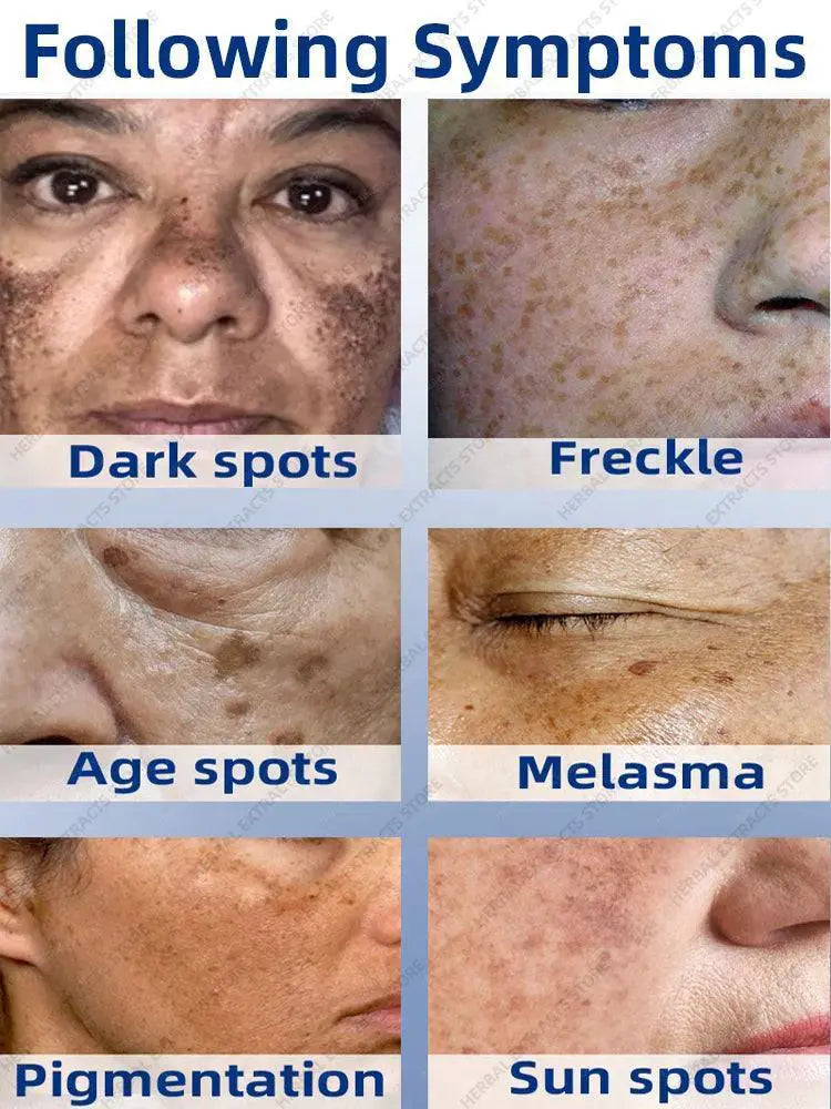 Spot Correcting Cream For Freckles And Age Spots Melasma