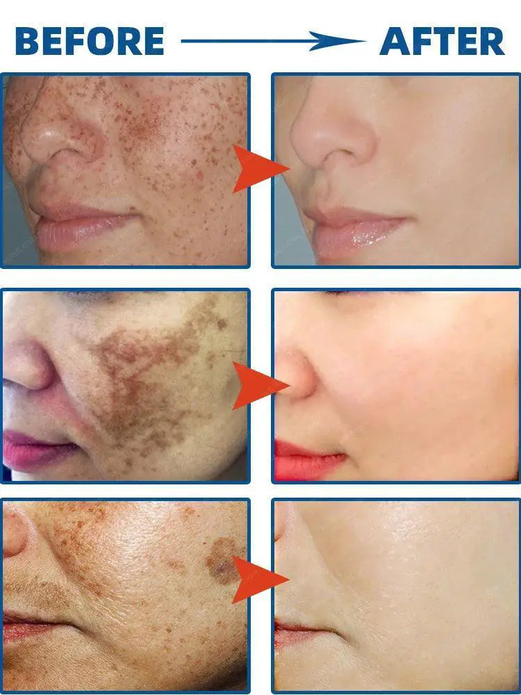 Spot Correcting Cream For Freckles And Age Spots Melasma