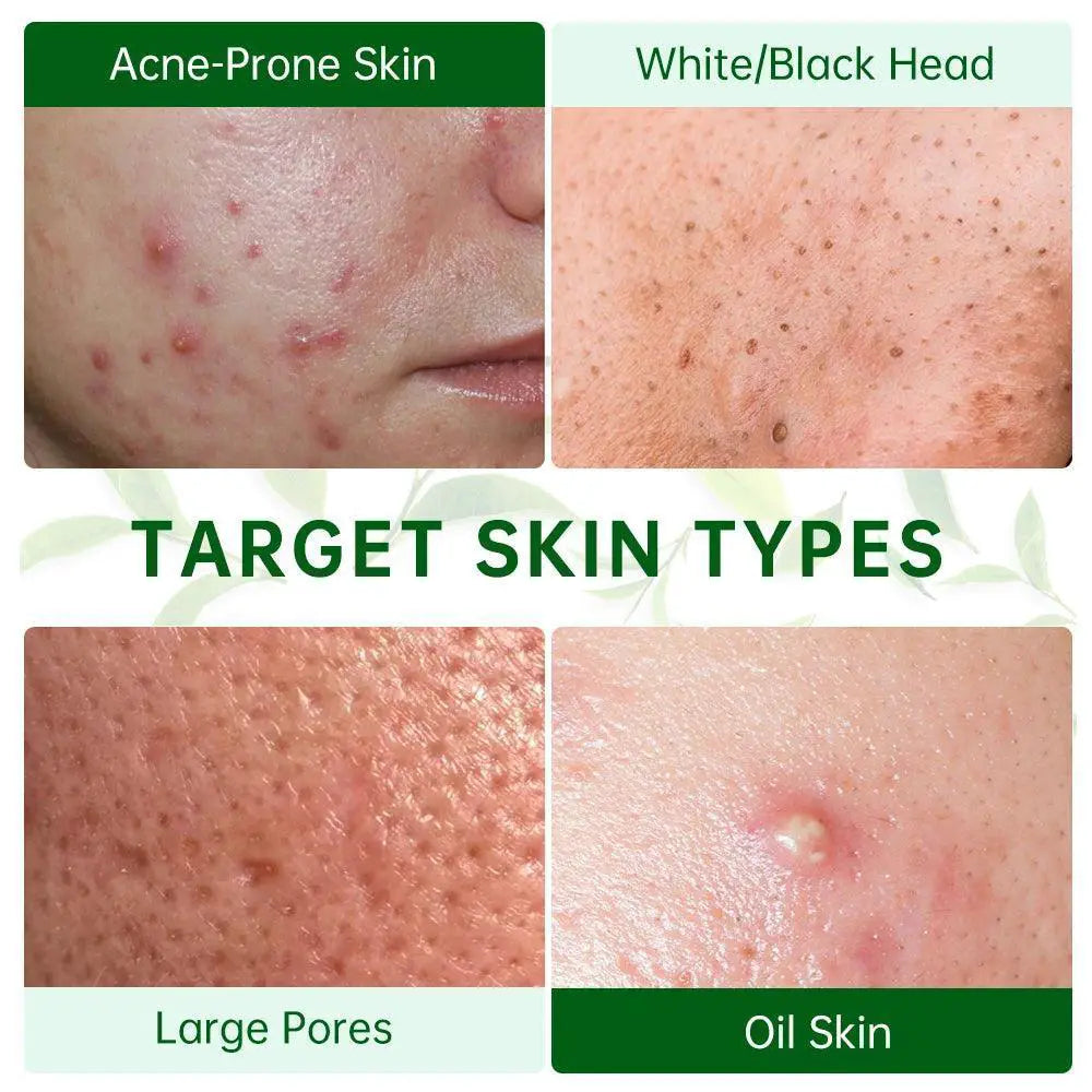 Tea Tree Clay Mask For Acne And Clear Skin 50ml Daily Use